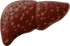 Dark red liver with dark and light spots that is in the decompensated cirrhosis stage.