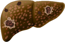 Spotted yellow liver with abrasions that is in the hepatocellular carcinoma stage.