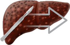 Spotted yellow liver with abrasions image with scalpel and arrow to denote liver transplant.